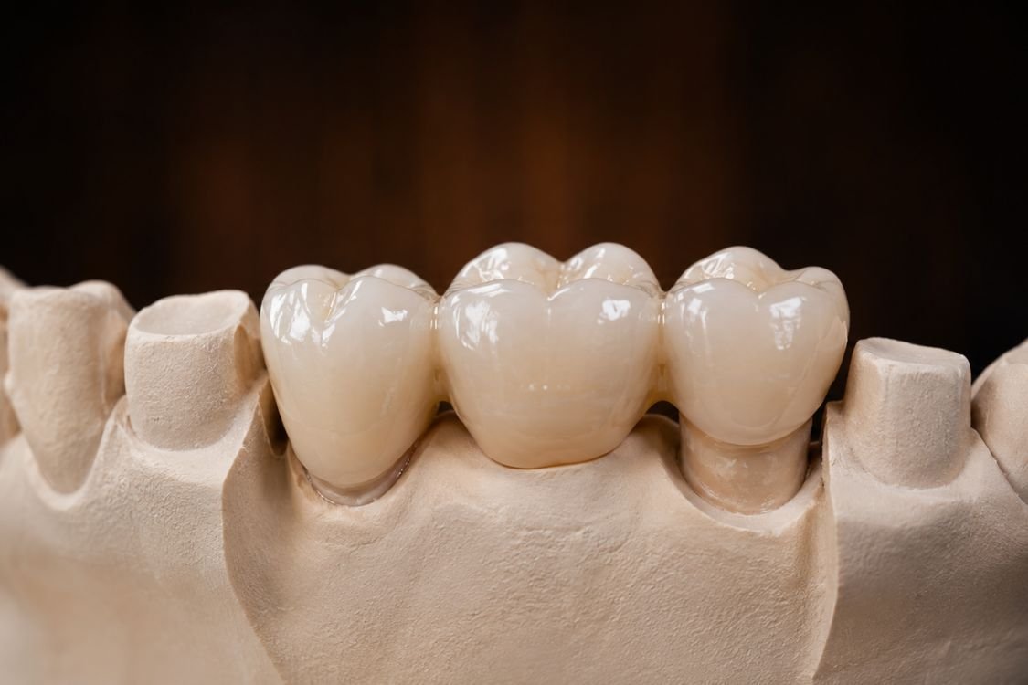 protesis-dental-fija-sobre-dientes-en-moralzarzal